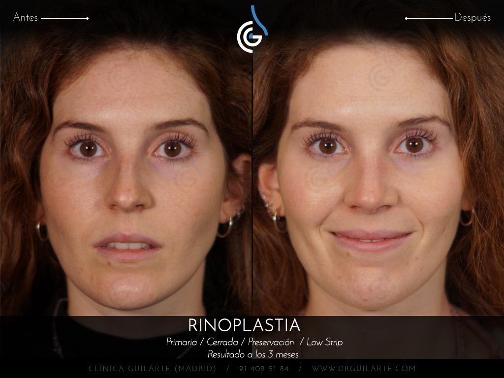Respirar mejor con el tabiqu recto después de la rinoplastia de Preservación Low Strip Let Down asimétrico
