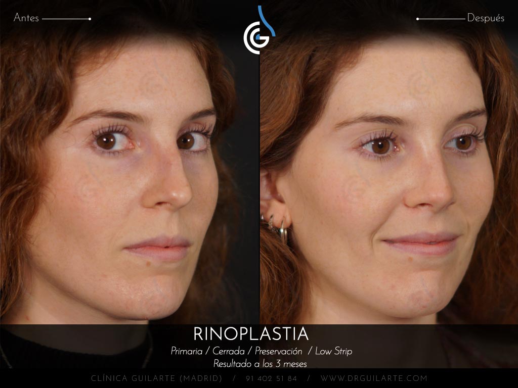 Respirar mejor con el tabiqu recto después de la rinoplastia de Preservación Low Strip Let Down asimétrico
