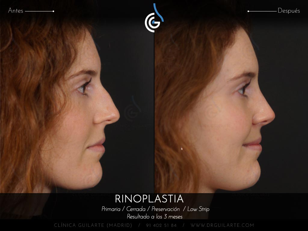 Respirar mejor con el tabiqu recto después de la rinoplastia de Preservación Low Strip Let Down asimétrico