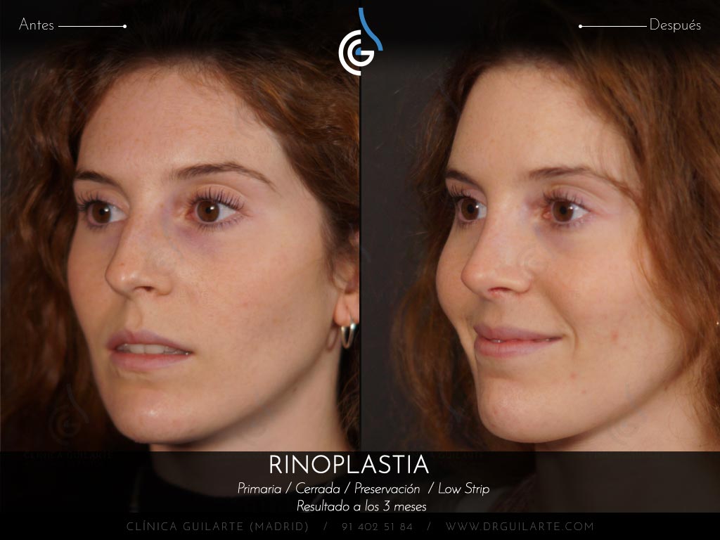 Respirar mejor con el tabiqu recto después de la rinoplastia de Preservación Low Strip Let Down asimétrico