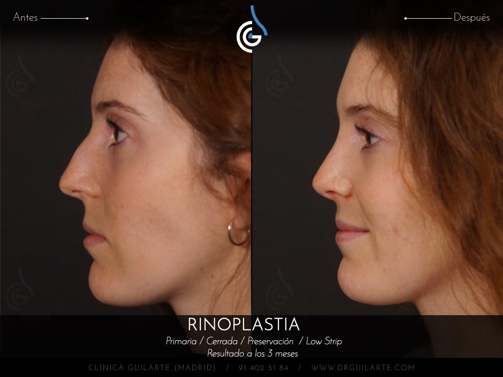 Respirar mejor con el tabiqu recto después de la rinoplastia de Preservación Low Strip Let Down asimétrico