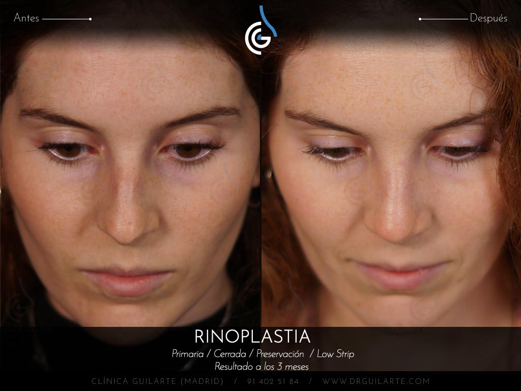 Respirar mejor con el tabiqu recto después de la rinoplastia de Preservación Low Strip Let Down asimétrico