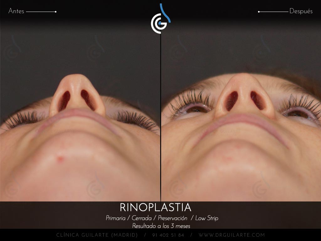 Respirar mejor con el tabiqu recto después de la rinoplastia de Preservación Low Strip Let Down asimétrico