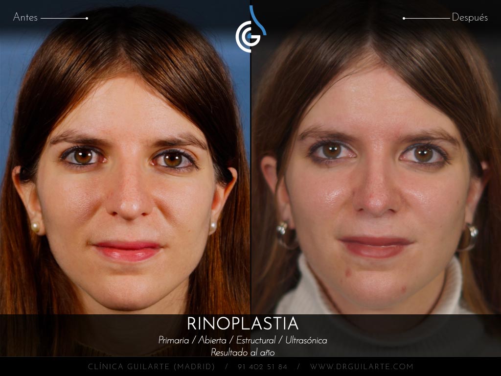 Caso real Clínica Guilarte: Rinoplastia ultrasónica estructural realizada en Madrid