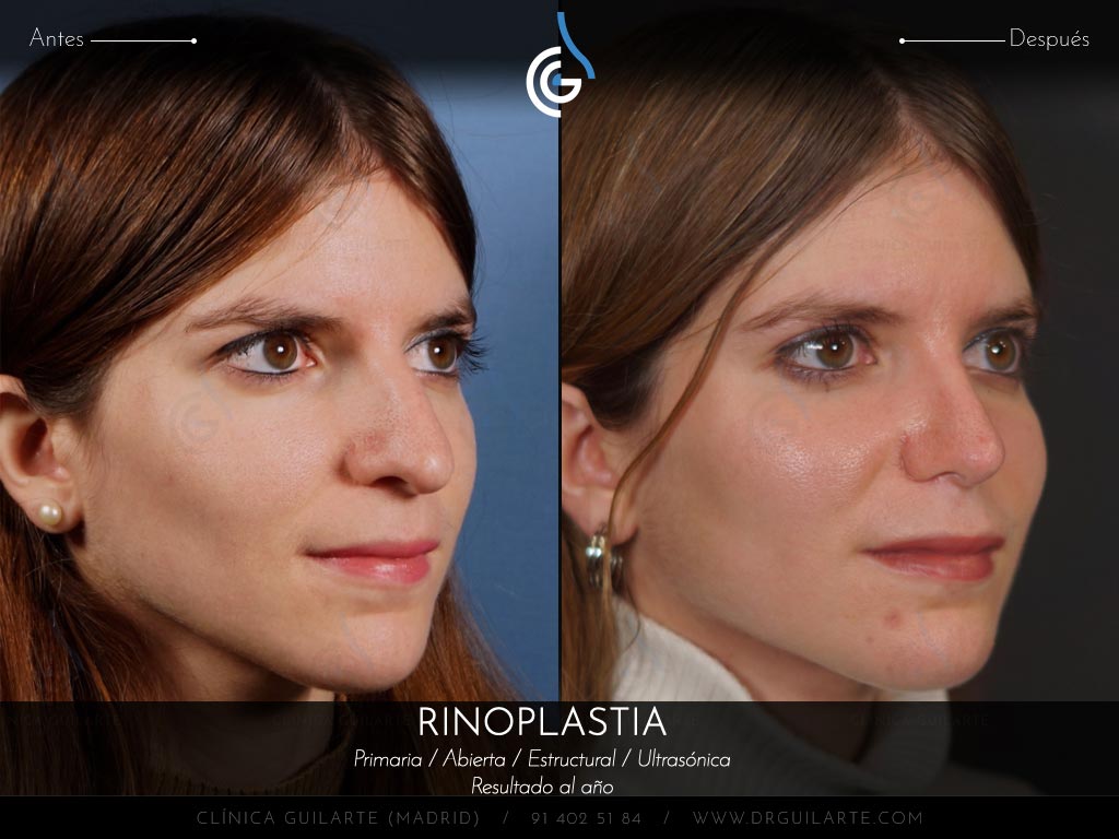Caso real Clínica Guilarte: Rinoplastia ultrasónica estructural realizada en Madrid