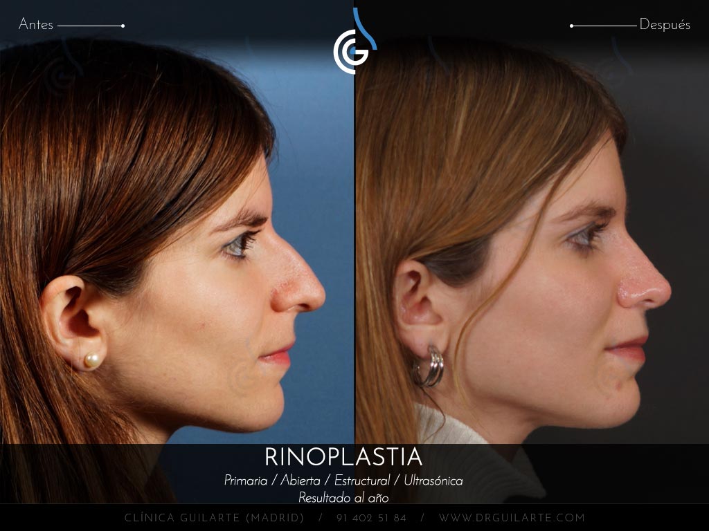 Caso real Clínica Guilarte: Rinoplastia ultrasónica estructural realizada en Madrid