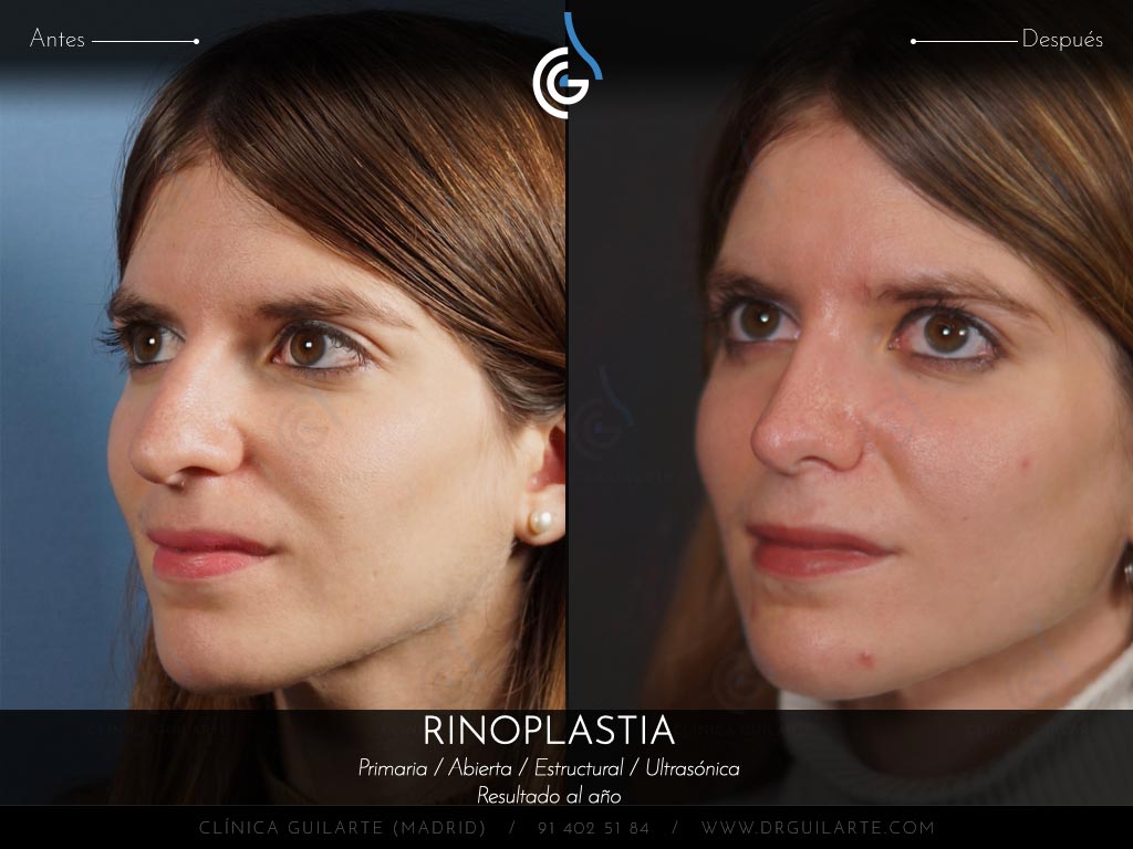 Caso real Clínica Guilarte: Rinoplastia ultrasónica estructural realizada en Madrid