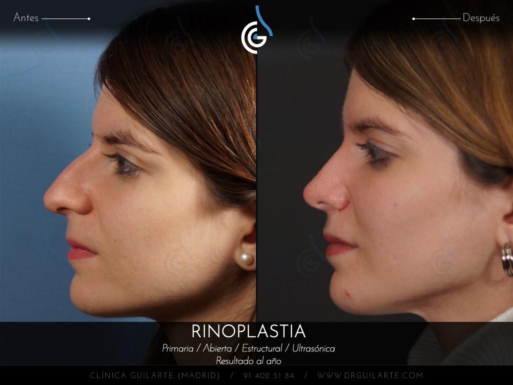 Caso real Clínica Guilarte: Rinoplastia ultrasónica estructural realizada en Madrid