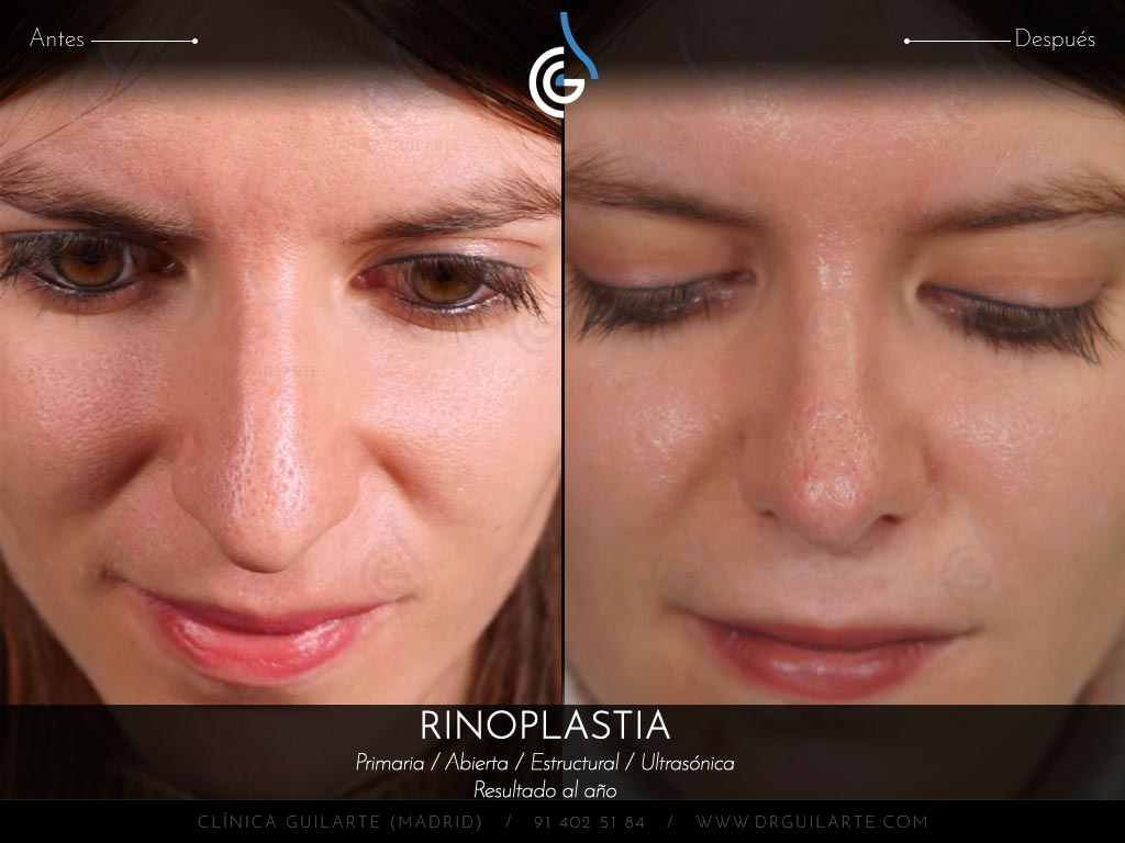 Caso real Clínica Guilarte: Rinoplastia ultrasónica estructural realizada en Madrid