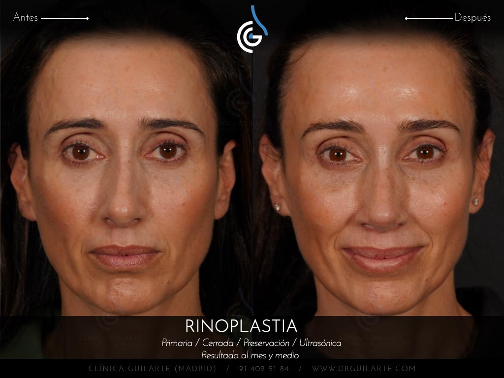 Doctor Guilarte soluciona la desviación del tabique nasal. Rinoplastia estética y funcional (IP)