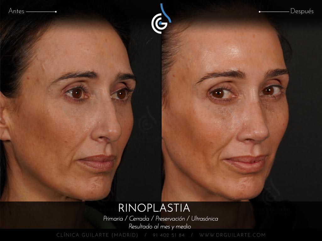 Doctor Guilarte soluciona la desviación del tabique nasal. Rinoplastia estética y funcional (IP)