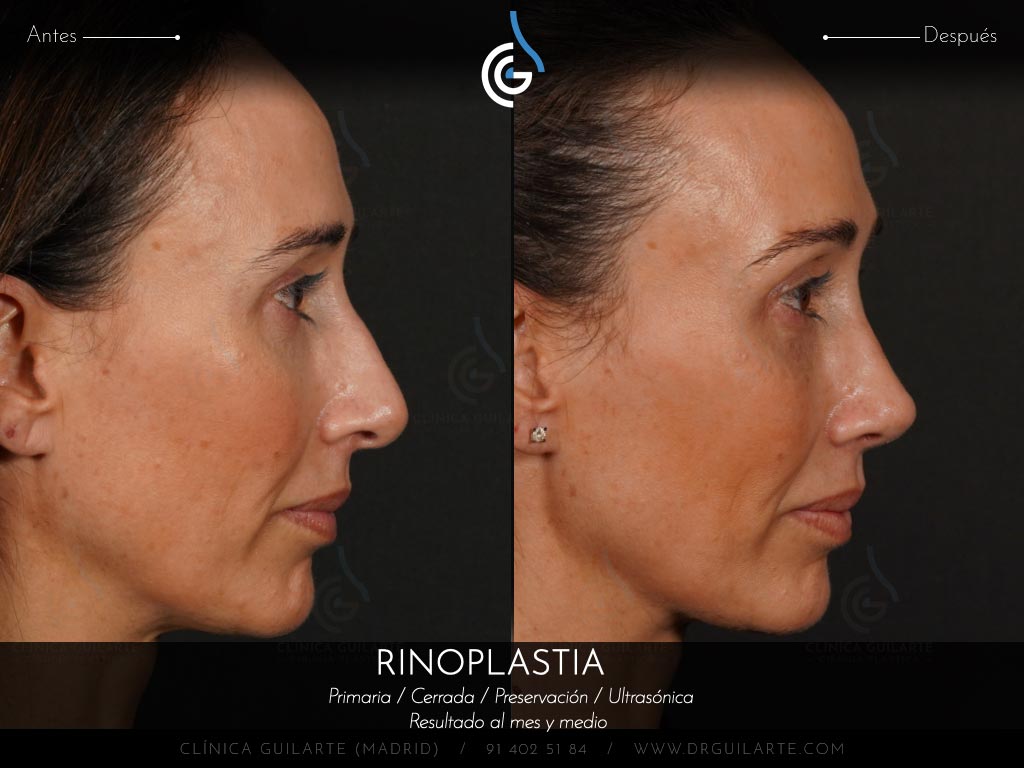 Doctor Guilarte soluciona la desviación del tabique nasal. Rinoplastia estética y funcional (IP)