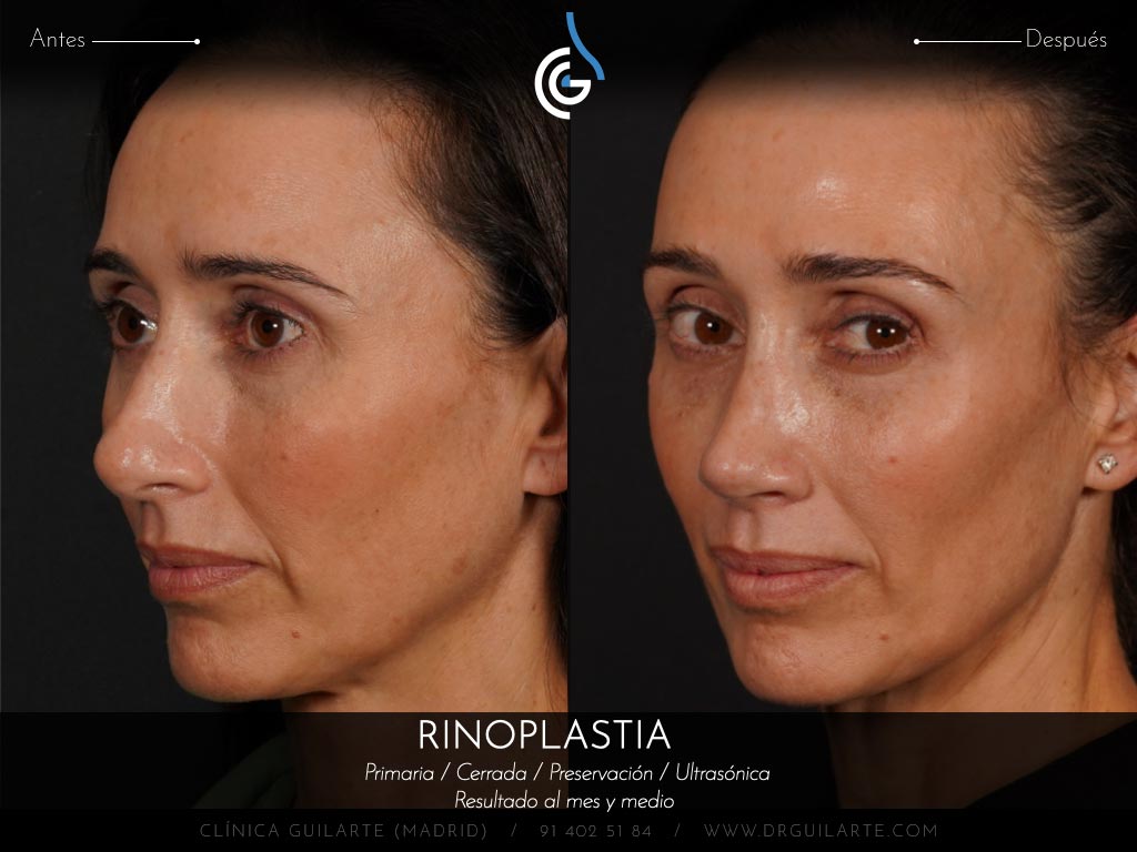 Doctor Guilarte soluciona la desviación del tabique nasal. Rinoplastia estética y funcional (IP)