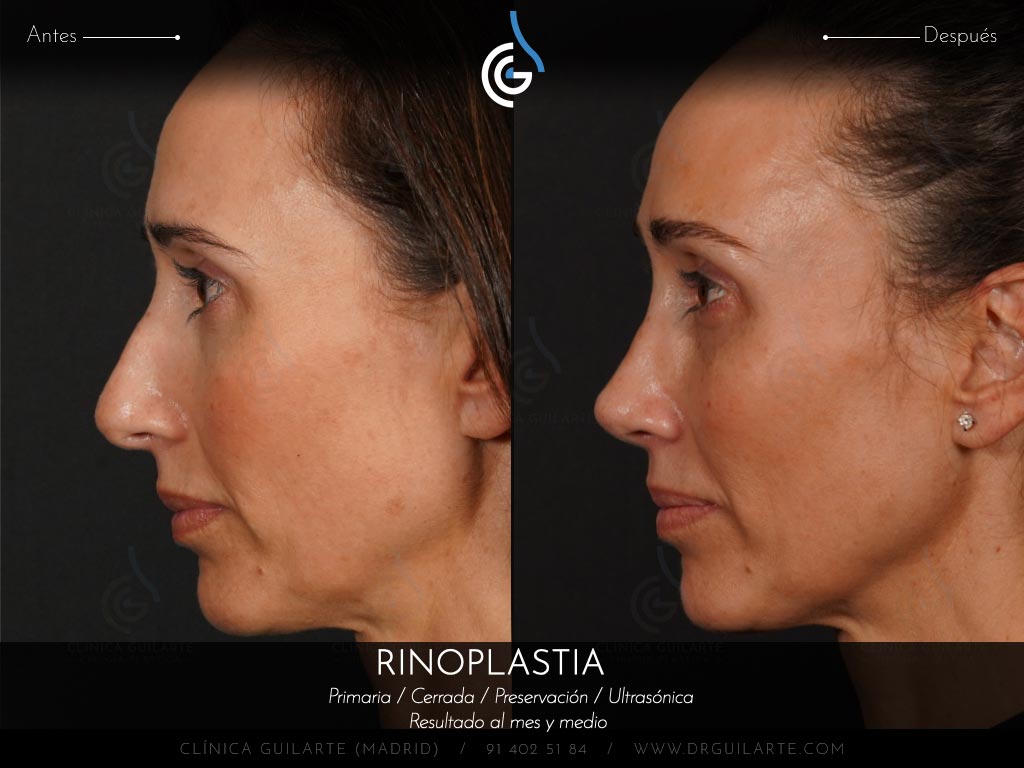 Doctor Guilarte soluciona la desviación del tabique nasal. Rinoplastia estética y funcional (IP)