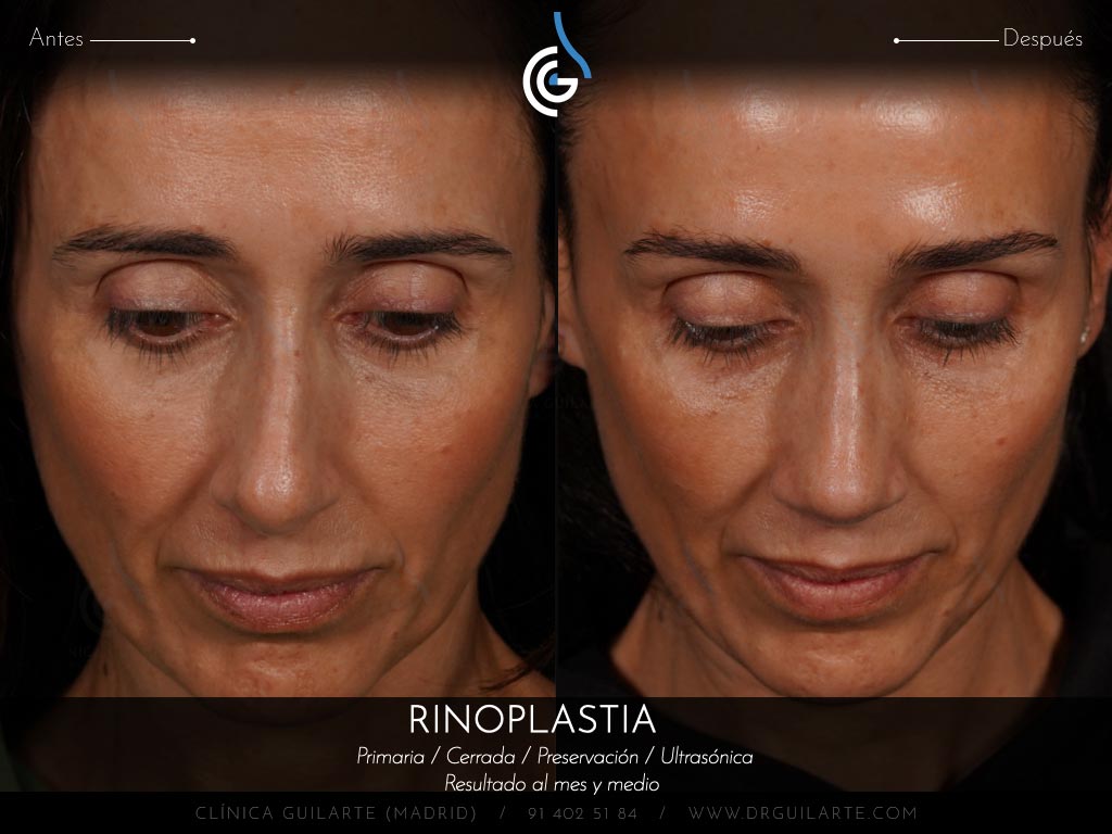 Doctor Guilarte soluciona la desviación del tabique nasal. Rinoplastia estética y funcional (IP)
