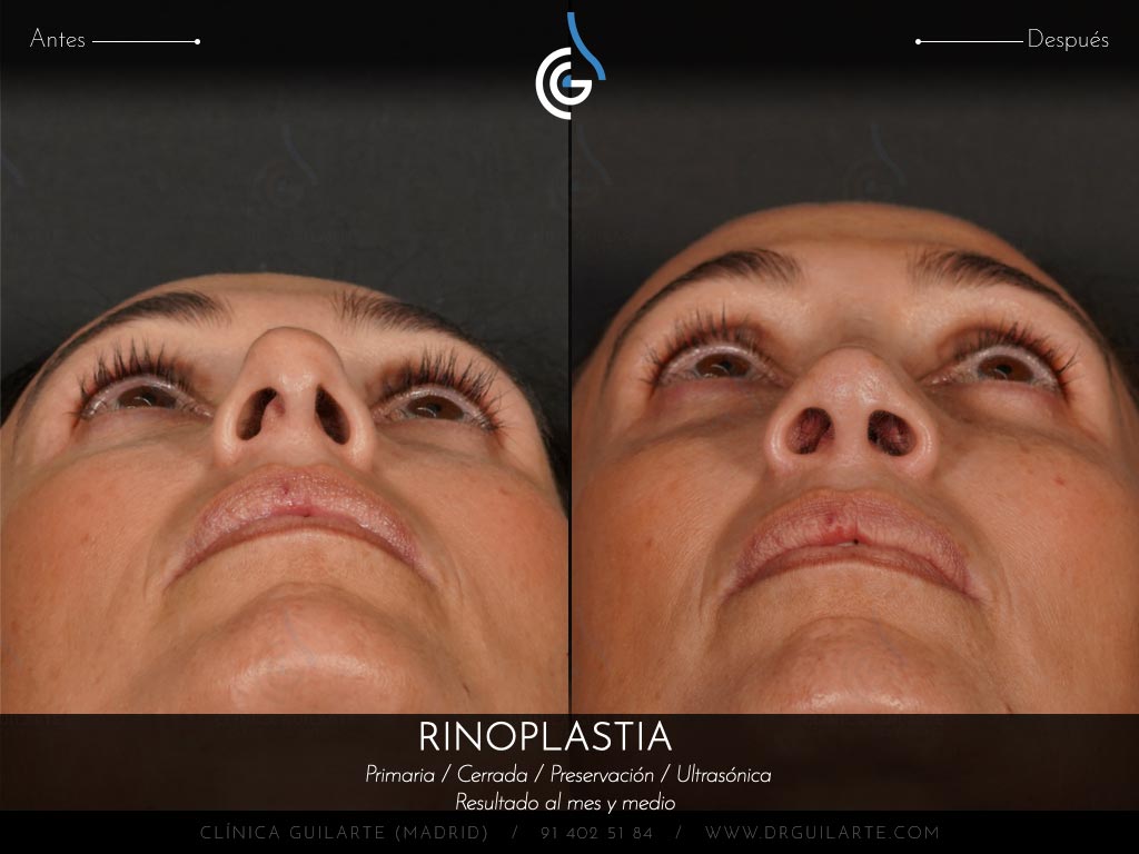 Doctor Guilarte soluciona la desviación del tabique nasal. Rinoplastia estética y funcional (IP)