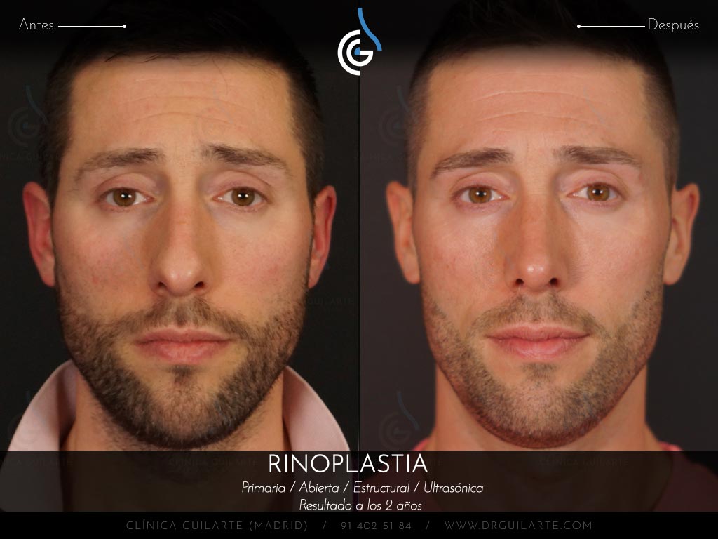 Foto antes y después de una rinoplastia a un paciente del Dr. Guilarte. Cirugía nasal masculina para conseguir una nariz definida y natual