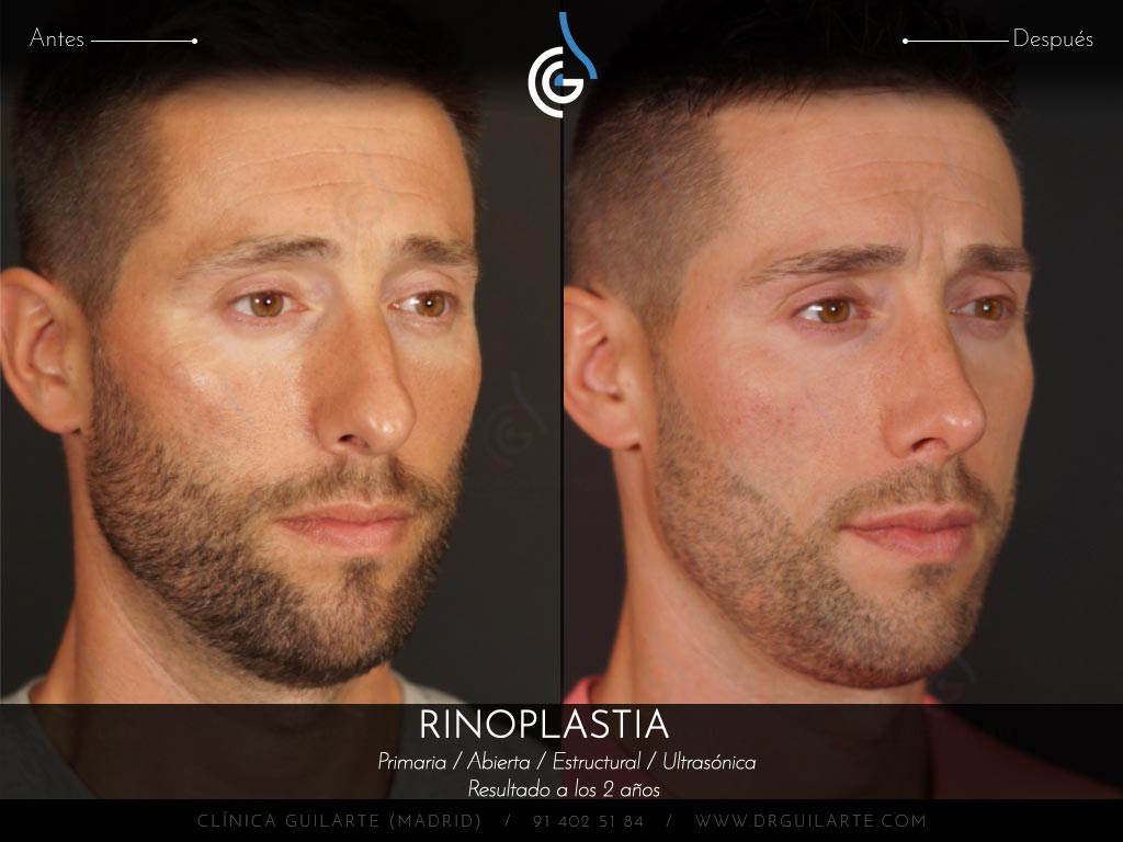Foto antes y después de una rinoplastia a un paciente del Dr. Guilarte. Cirugía nasal masculina para conseguir una nariz definida y natual