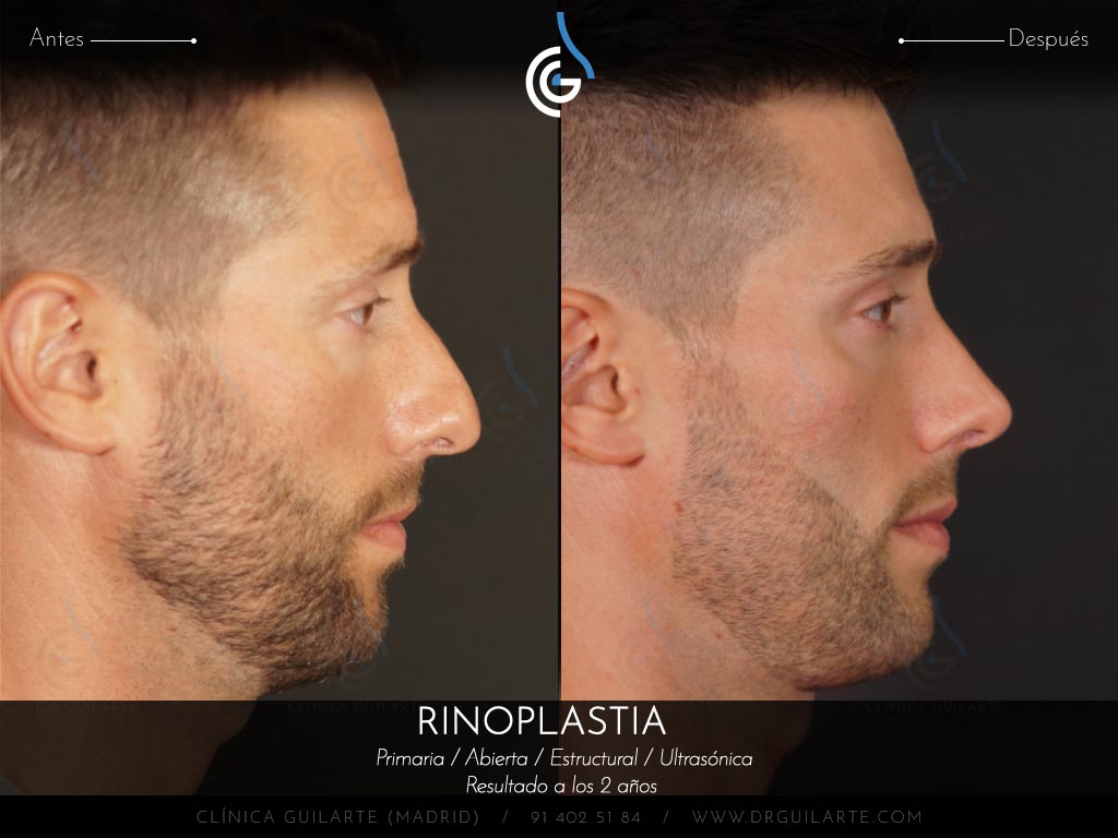 Foto antes y después de una rinoplastia a un paciente del Dr. Guilarte. Cirugía nasal masculina para conseguir una nariz definida y natual