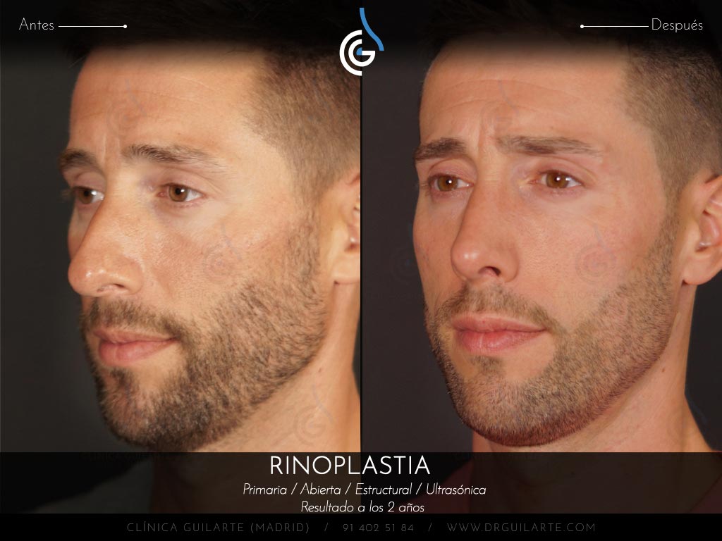 Foto antes y después de una rinoplastia a un paciente del Dr. Guilarte. Cirugía nasal masculina para conseguir una nariz definida y natual