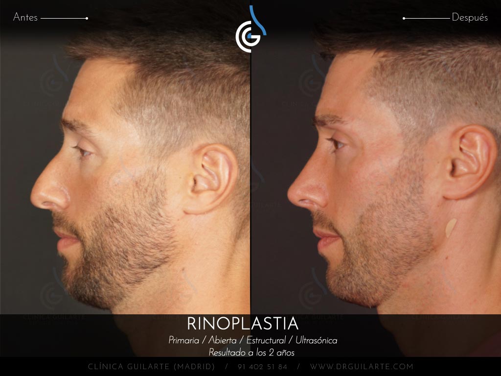 Foto antes y después de una rinoplastia a un paciente del Dr. Guilarte. Cirugía nasal masculina para conseguir una nariz definida y natual