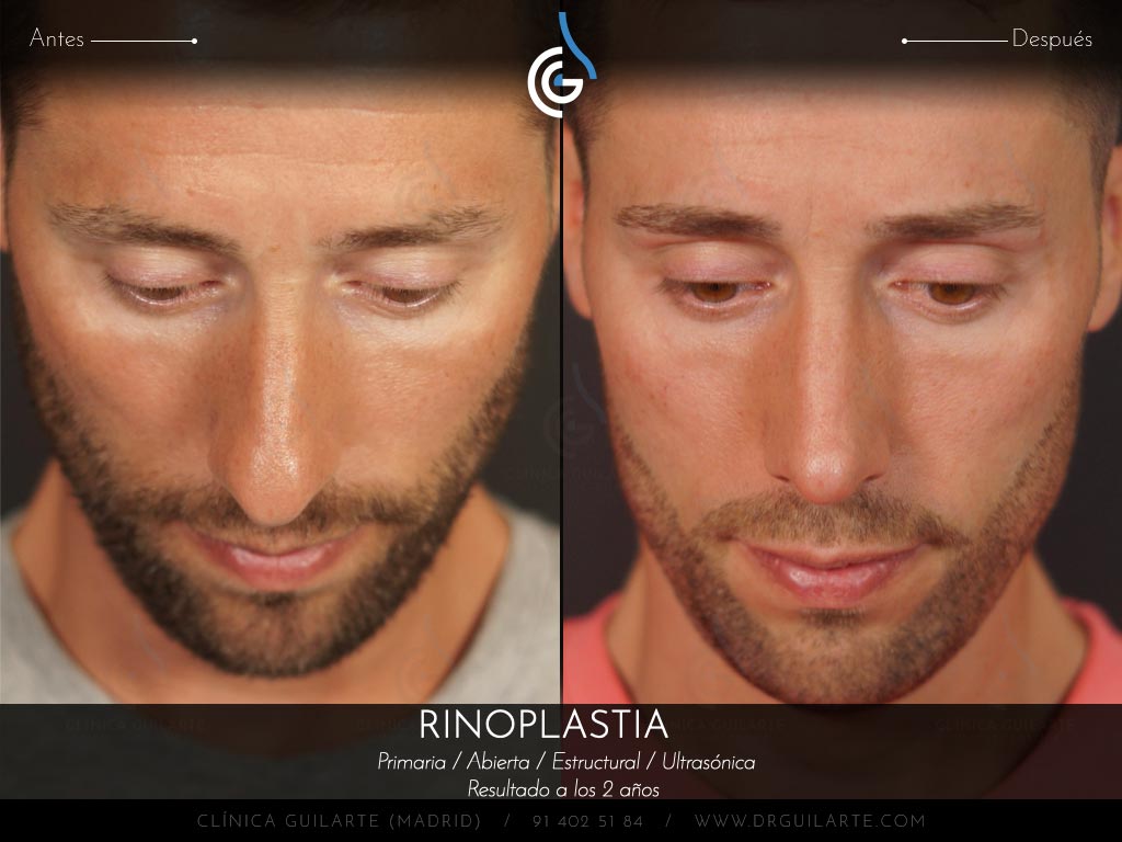 Foto antes y después de una rinoplastia a un paciente del Dr. Guilarte. Cirugía nasal masculina para conseguir una nariz definida y natual