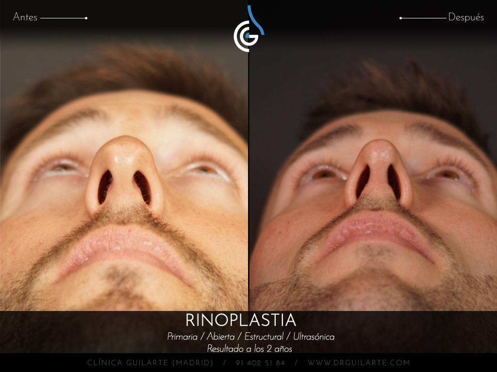 Foto antes y después de una rinoplastia a un paciente del Dr. Guilarte. Cirugía nasal masculina para conseguir una nariz definida y natual