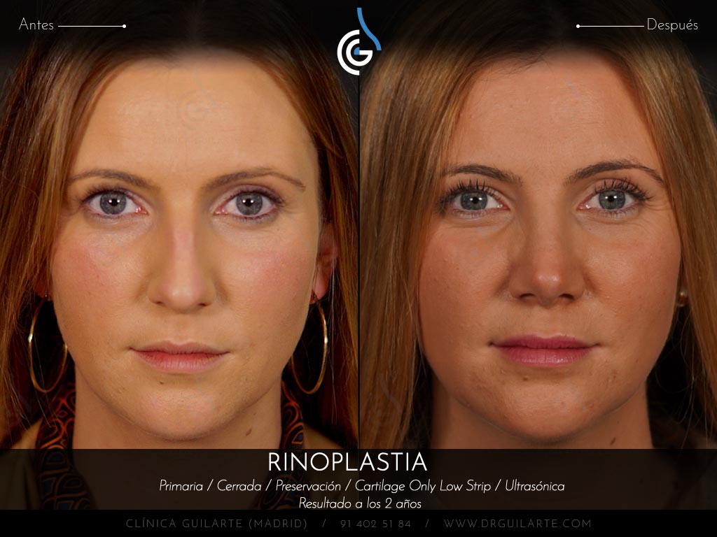 Resultado rinoplastia de preservación cerrada en plano SubP y huesos parcialmente tratados con ultrasonidos