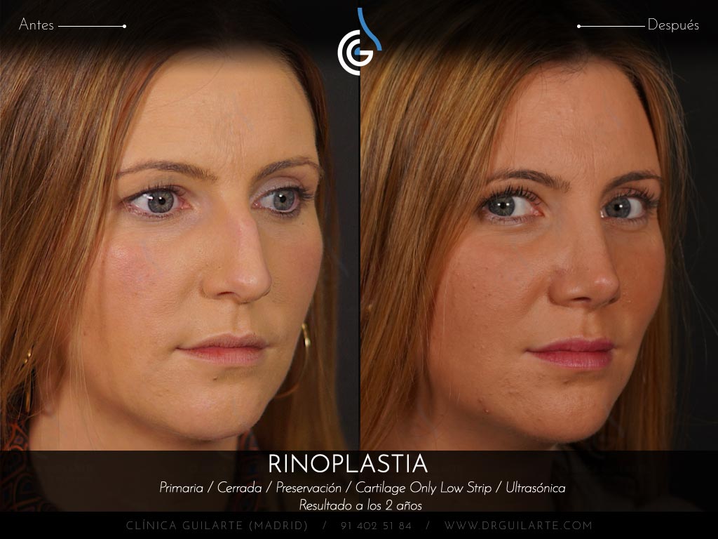 Resultado rinoplastia de preservación cerrada en plano SubP y huesos parcialmente tratados con ultrasonidos