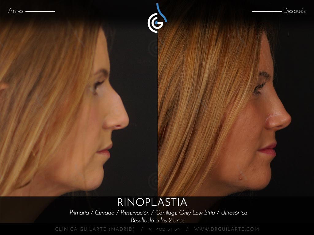 Resultado rinoplastia de preservación cerrada en plano SubP y huesos parcialmente tratados con ultrasonidos