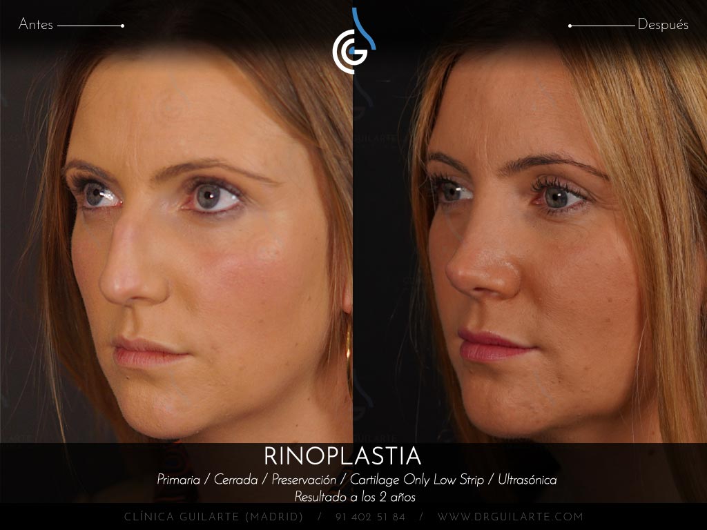 Resultado rinoplastia de preservación cerrada en plano SubP y huesos parcialmente tratados con ultrasonidos