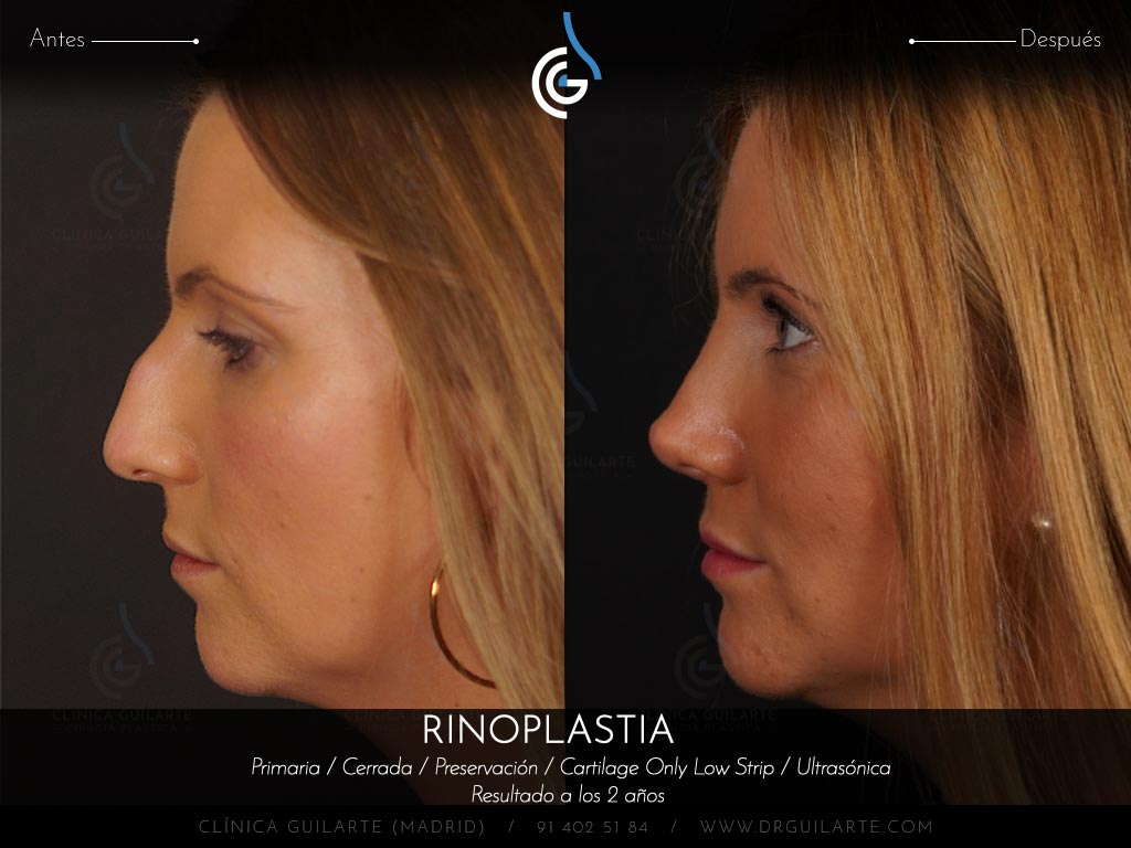 Resultado rinoplastia de preservación cerrada en plano SubP y huesos parcialmente tratados con ultrasonidos