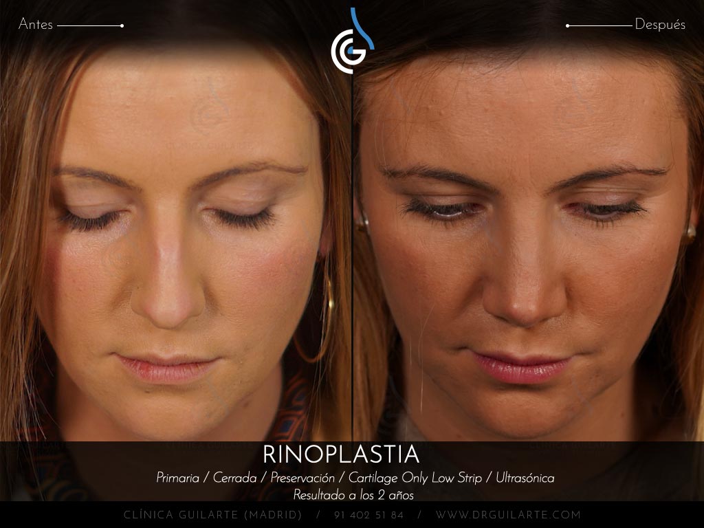 Resultado rinoplastia de preservación cerrada en plano SubP y huesos parcialmente tratados con ultrasonidos