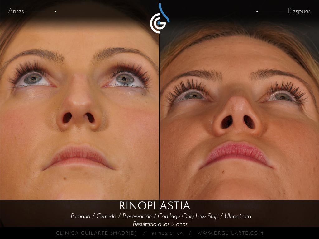 Resultado rinoplastia de preservación cerrada en plano SubP y huesos parcialmente tratados con ultrasonidos