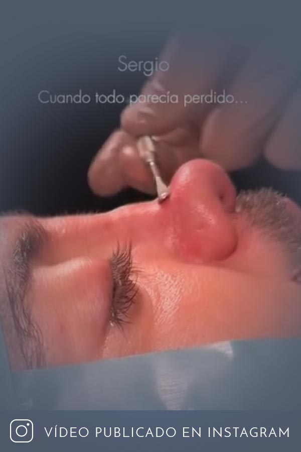 Rinoplastia terciaria, haciendo milagros en la Clínica Guilarte
